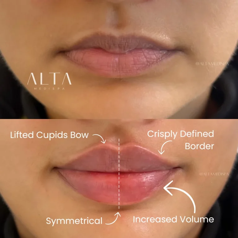 Lips Augmentation